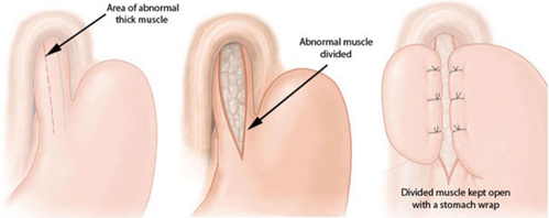 Difficulty in Swallowing: Can it be Achalasia Cardia?