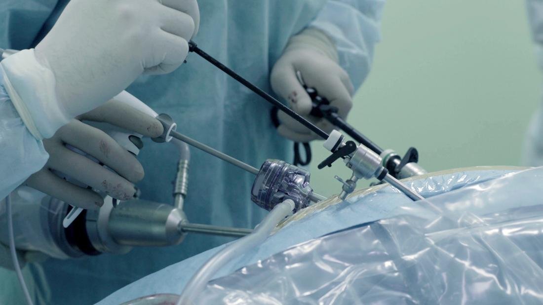 Did you know that a single surgery can cure multiple abdominal problems by Laparoscopy?